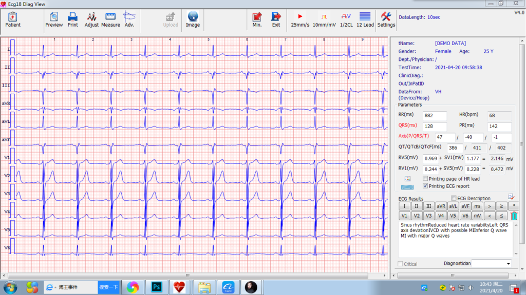 windows simultaneous 12 channel pc based ecg electrocardiograma portatil