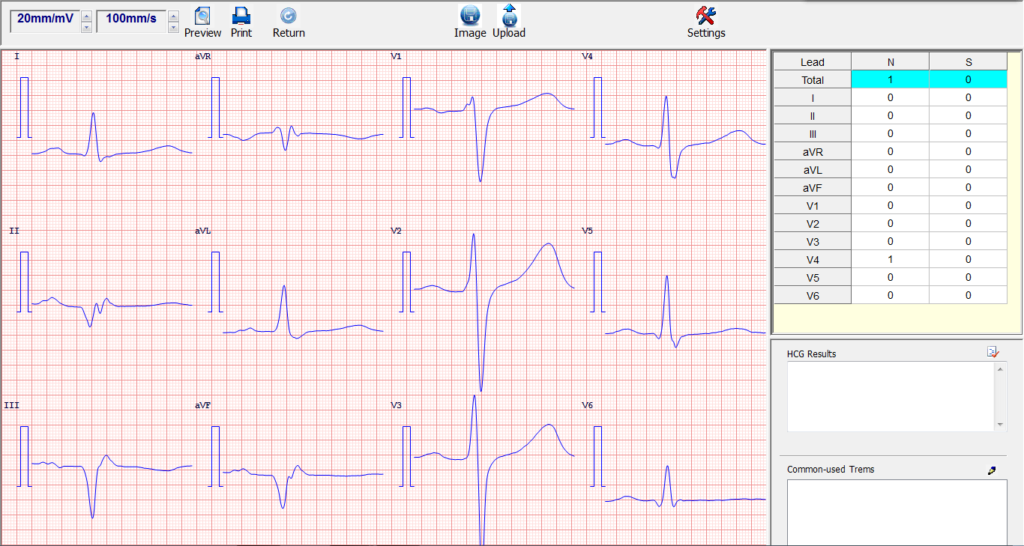 windows simultaneous 12 channel pc based ecg electrocardiograma portatil