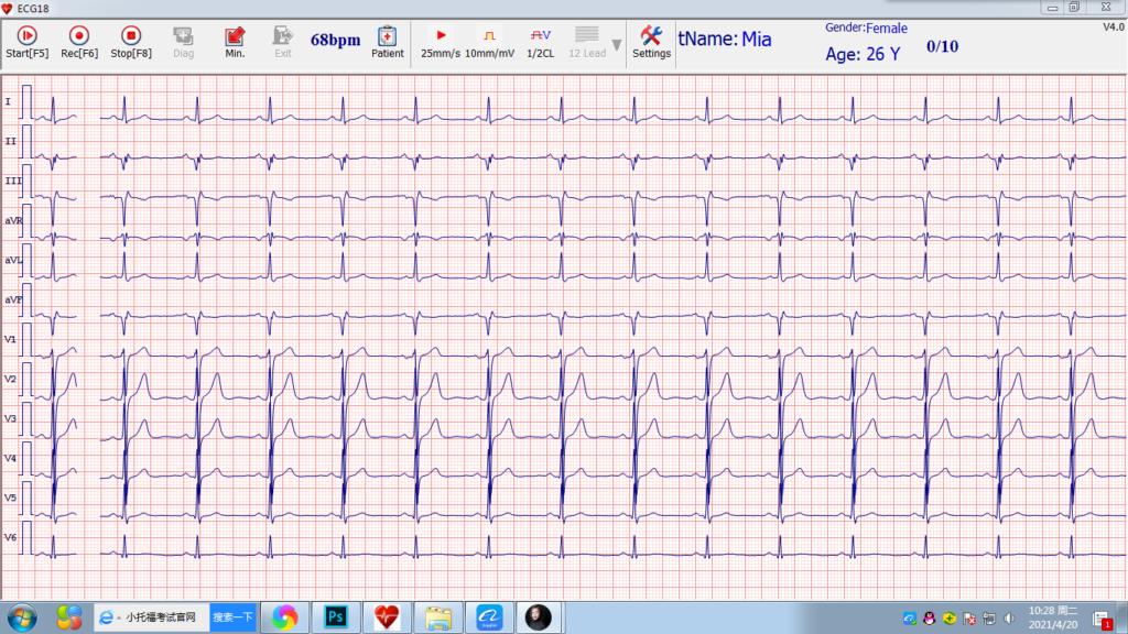 windows simultaneous 12 channel pc based ecg electrocardiograma portatil