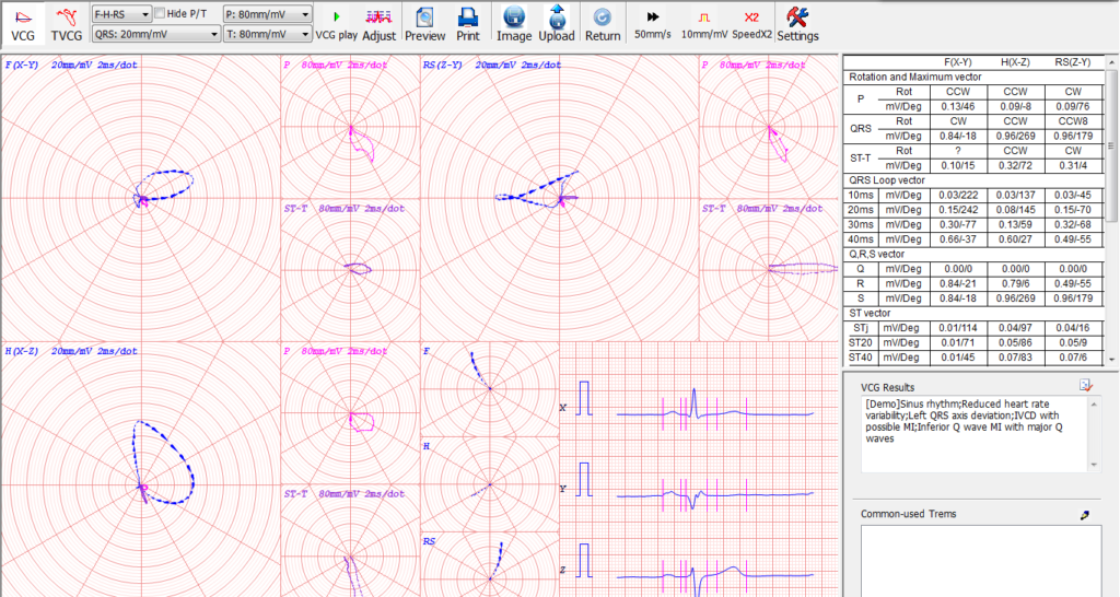 windows simultaneous 12 channel pc based ecg electrocardiograma portatil