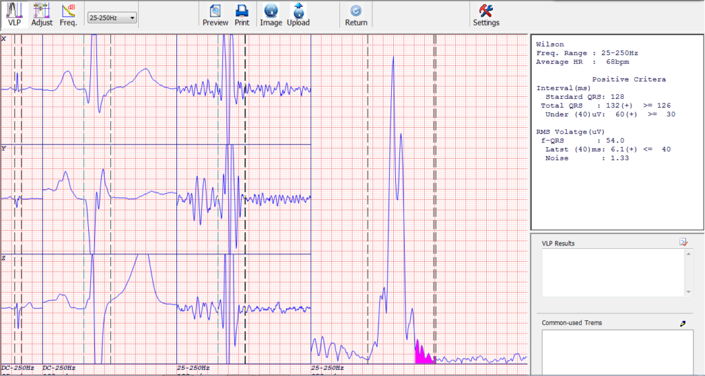 windows simultaneous 12 channel pc based ecg electrocardiograma portatil